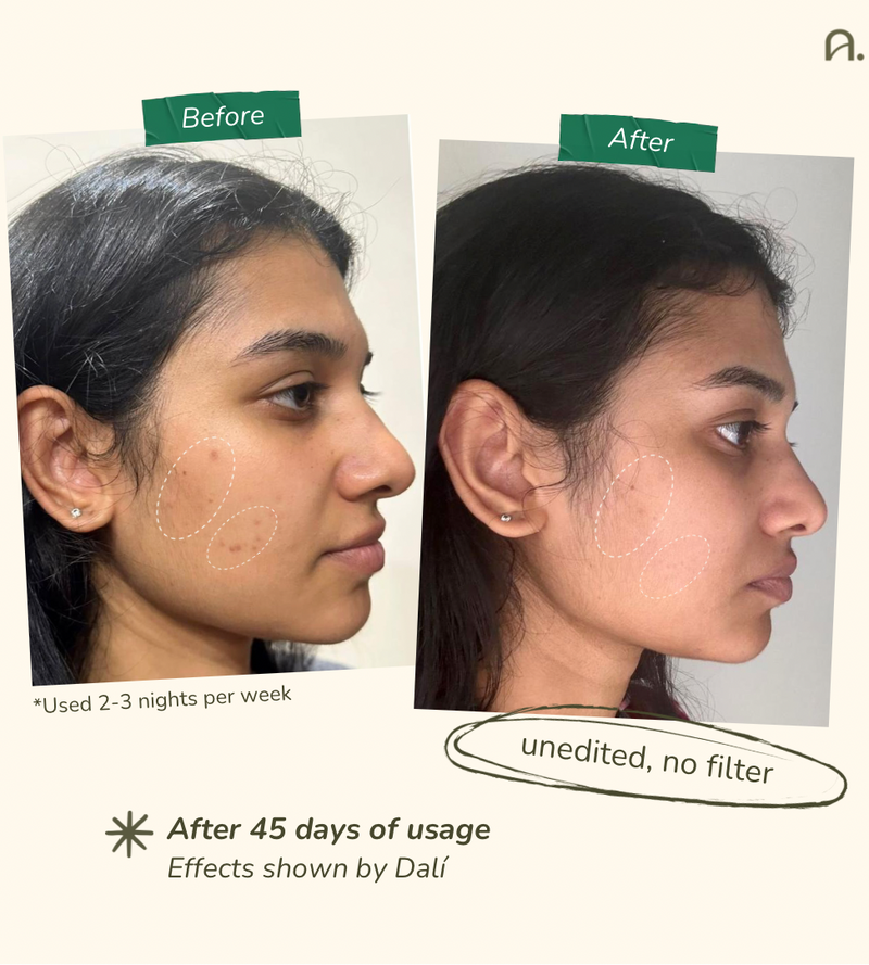 Dalí: Hyperpigmentation Cream
