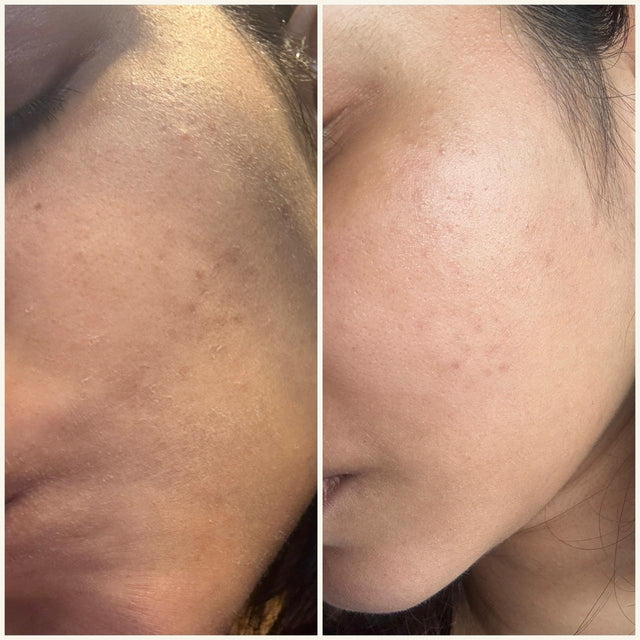 Before image in the Arō customer comparison: a close-up of the cheek with visible dry, flaky patches.
