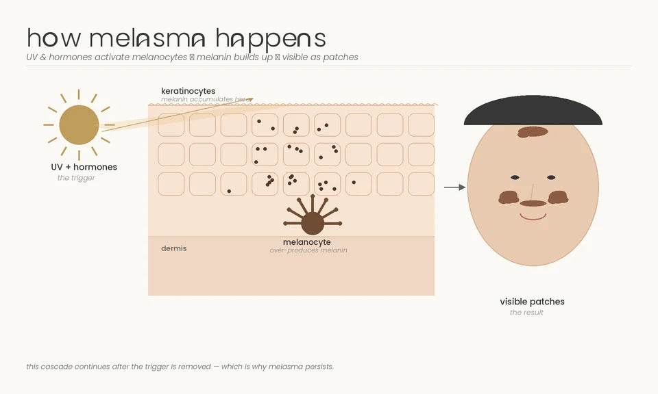 Diagram showing UV and hormone signals, melanocytes, melanin accumulation in keratinocytes and visible melasma patches.